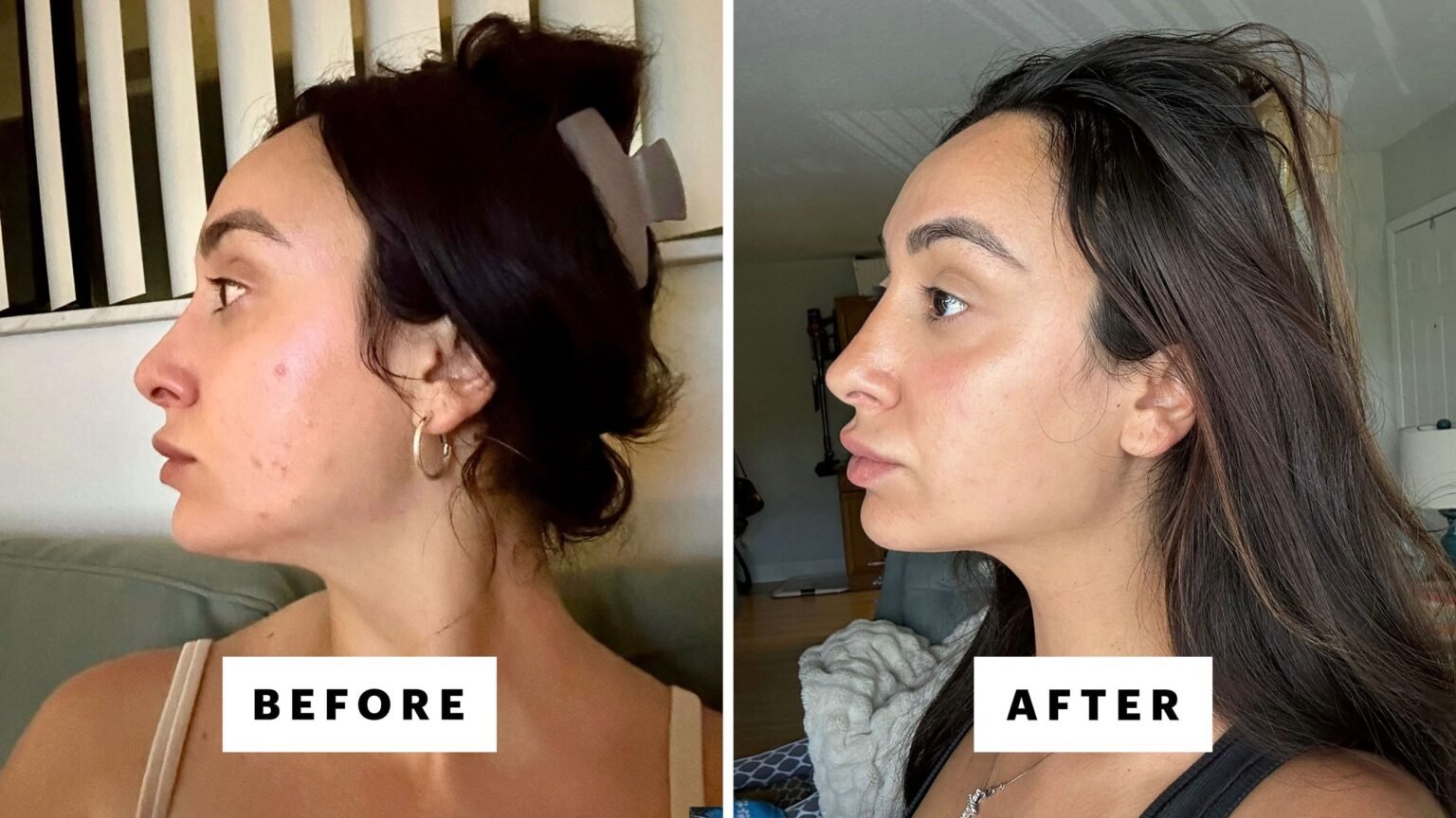 3 Best Dark Spot Correctors for Acne Scars, Melasma, and More