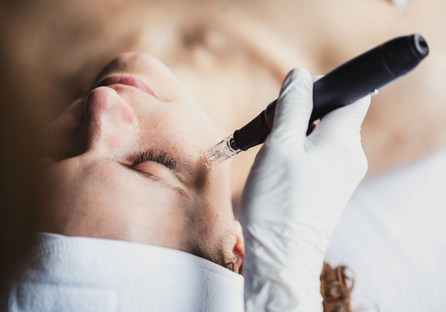You’re Seeing PDRN Everywhere, But Its Best Use May Surprise You Microneedling procedure on face, a treatment that benefits from post-procedure PDRN recovery